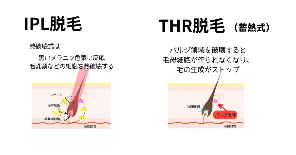 IPL脱毛と蓄熱式脱毛の違い